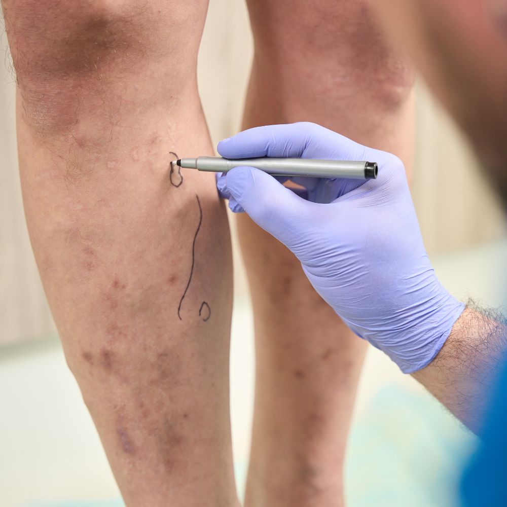 Dermatologist performing sclerotherapy on leg veins