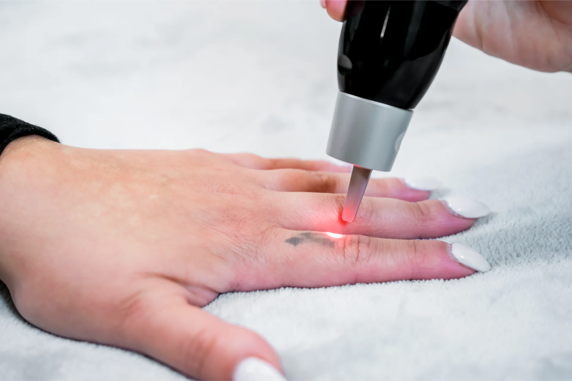 Laser tattoo removal consultation at Gold Skin Care Center Nashville