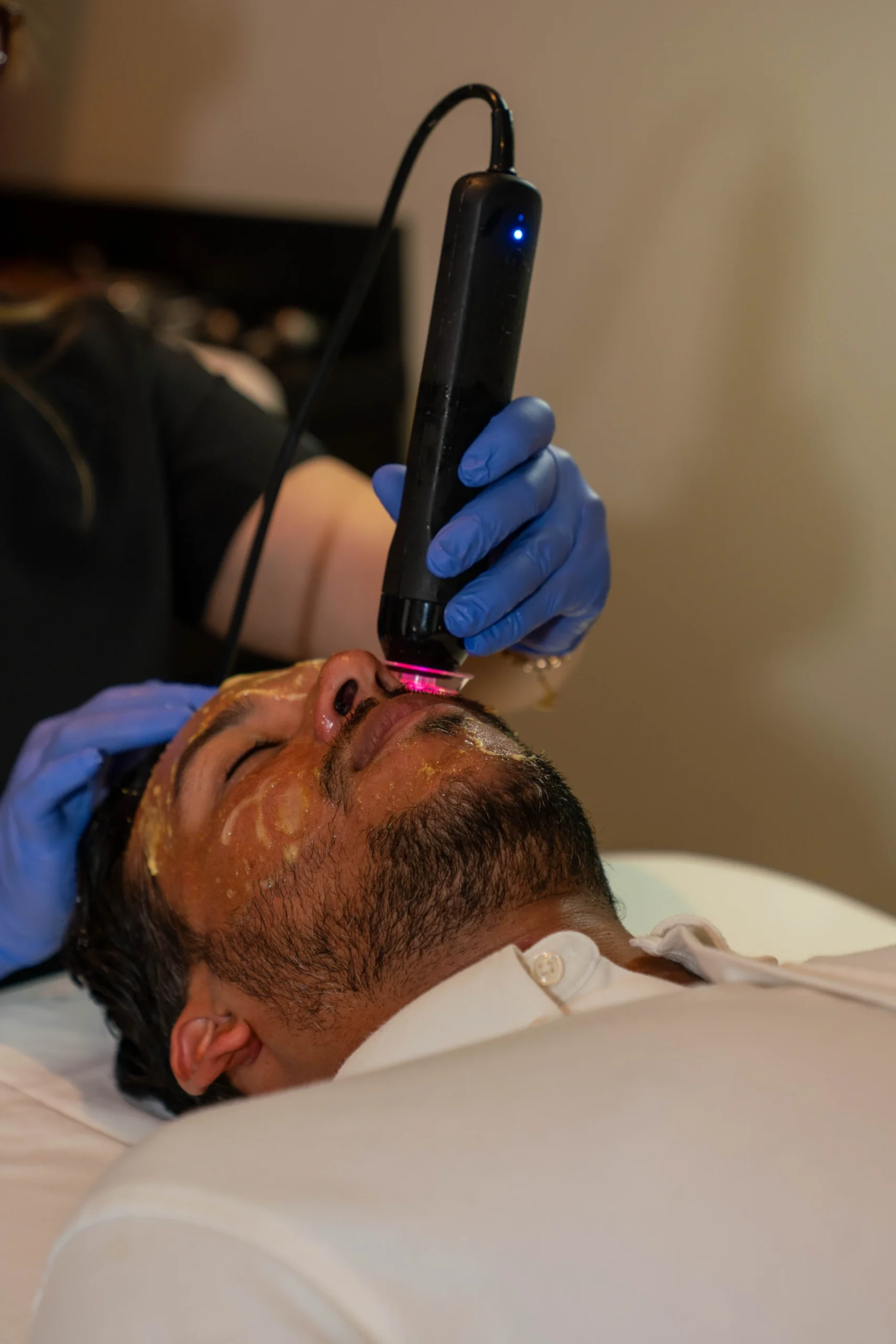 Advanced laser device used for skin rejuvenation targeting sun damage and hyperpigmentation Nashville