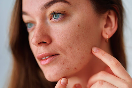 Adult acne treatment and breakout prevention skincare consultation
