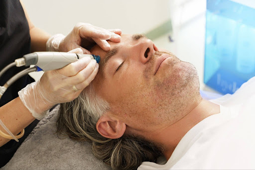 Patient receiving microneedling radiofrequency skin tightening treatment at Gold Skin Care Center Nashville TN